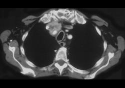 Substernal Thyroid - CTisus CT Scan