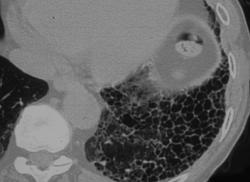 Honeycombing Due to Scleroderma - CTisus CT Scan