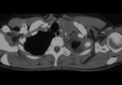 Supraclavicular Nodes - CTisus CT Scan