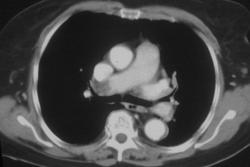 Pe - CTisus CT Scan