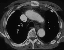 Pleural Plaques Secondary to Asbestos Exposure - CTisus CT Scan