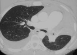 Left Upper Lobe Collapse Due to Mucus Plug - CTisus CT Scan