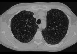 Eosinophilic Granuloma (EG) - CTisus CT Scan