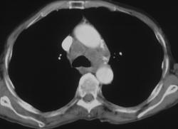 Metastatic Breast Cancer - CTisus CT Scan