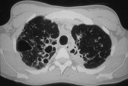 Cystic Fibrosis - CTisus CT Scan