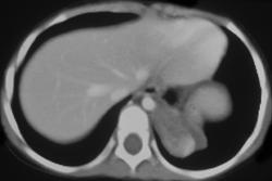 Sequestration - CTisus CT Scan