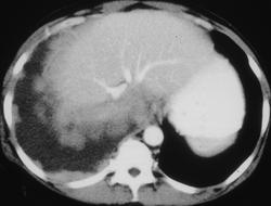 Metastases to the Pleura - CTisus CT Scan