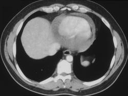 Pericardial Effusion - CTisus CT Scan