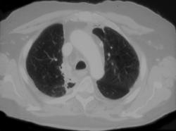 Radiation Changes in the Mediastinum - CTisus CT Scan