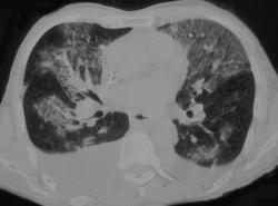 Pulmonary Hemorrhage - CTisus CT Scan