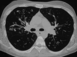 Cystic Fibrosis - CTisus CT Scan