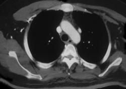 Persistent Lt SVC - CTisus CT Scan