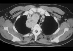 Substernal Thyroid - CTisus CT Scan