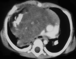 Mature Teratoma - CTisus CT Scan