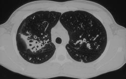 Cystic Fibrosis - CTisus CT Scan