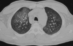 Cytomegalovirus (CMV) - CTisus CT Scan