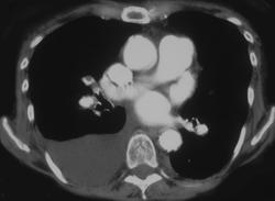 Pulmonary Embolism (PE) With Infarct - CTisus CT Scan