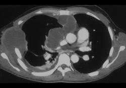 Recurrent Chondrosarcoma of the Chest Wall - CTisus CT Scan