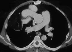 Heart Transplant - CTisus CT Scan