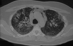 Idiopathic Pulmonary Fibrosis (IPF) With Pneumomediastinum - CTisus CT Scan