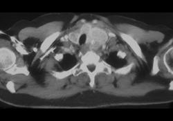 Substernal Thyroid With Goiter - CTisus CT Scan