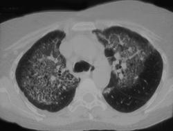 Idiopathic Pulmonary Fibrosis (IPF) - CTisus CT Scan