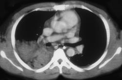 Pulmonary Contusion - CTisus CT Scan