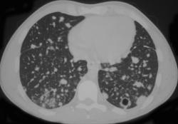 Nocardia in A Patient With Chronic Granulomatous Disease - CTisus CT Scan