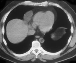 Pericardial Cyst - CTisus CT Scan