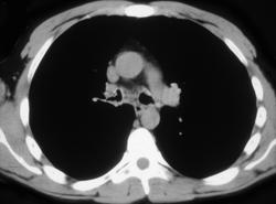 Rhinoscleroma - CTisus CT Scan