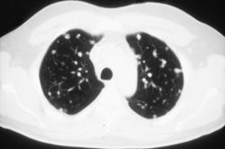 Metastatic Colon Cancer - CTisus CT Scan