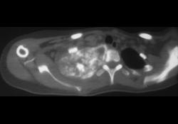 Osteosarcoma of the First Rib - CTisus CT Scan