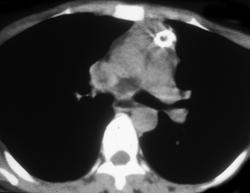 Thymoma - CTisus CT Scan