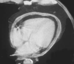 Pericarditis - CTisus CT Scan