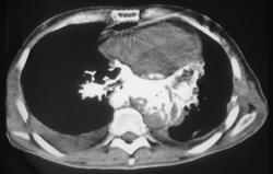 Metastatic Osteosarcoma Involves the Left Atrium and Pulmonary Veins - CTisus CT Scan