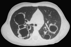 Tracheobronchial Papillomatosis - CTisus CT Scan