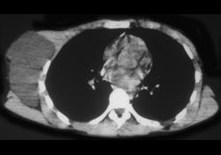 Cystic Hygroma - CTisus CT Scan