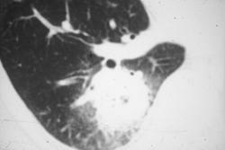 Invasive Pulmonary Aspergillosis - CTisus CT Scan