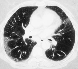 Bronchiolitis Obliterans Organizing Pneumonia (BOOP) - CTisus CT Scan