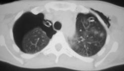 Spontaneous Pneumothorax in An AIDS Patient - CTisus CT Scan