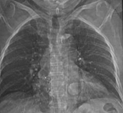 Calcified Atrial Myxoma - CTisus CT Scan