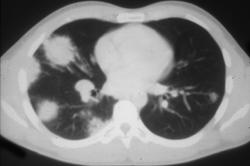 Alveolar Sarcoidosis - CTisus CT Scan