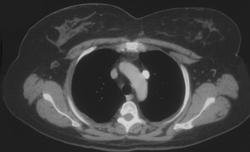 Lt SVC With Drainage Into the Right Atrium - CTisus CT Scan