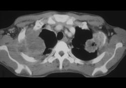 Lung Cancer Invades Chest Wall - CTisus CT Scan