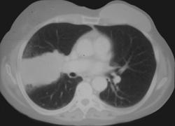 Metastases to the Hilum From Breast Cancer - CTisus CT Scan