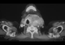 Substernal Thyroid - CTisus CT Scan