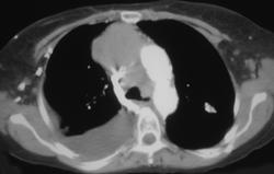 SVC Syndrome Due to Lymphoma - CTisus CT Scan