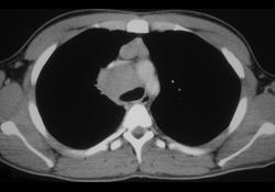 Lymphoma - CTisus CT Scan