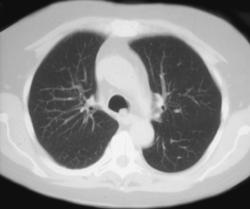 Inspisated Mucus in the Airway - CTisus CT Scan