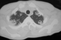 Septic Emboli - CTisus CT Scan